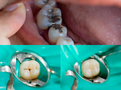 Dental Fillings - Hesperia Dentist