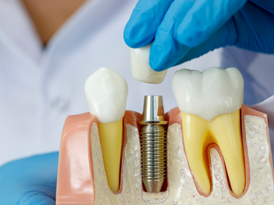 Dental Implants