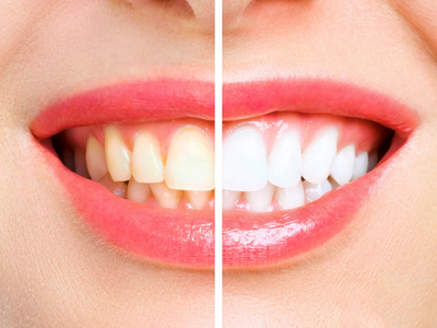 Dental Veneers - Hesperia dentist