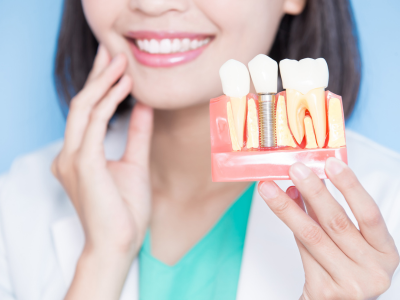 Factors Affecting Dental Implant Durability