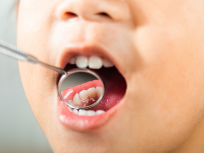 Can Cavities Cause Cancer?