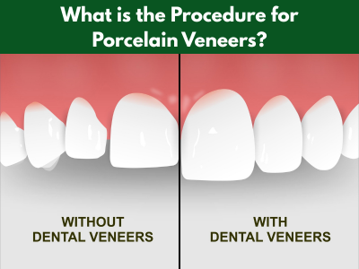 Porcelain veneers procedure at Maple Dental Hesperia