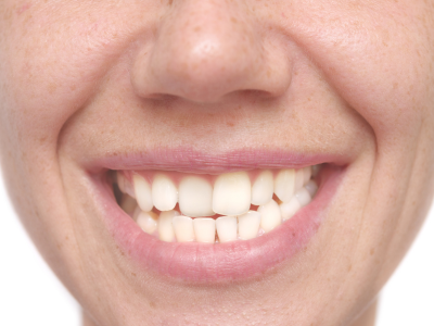 Dental bonding for crooked teeth