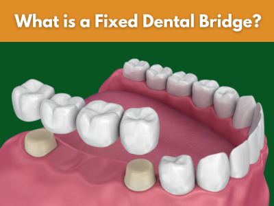 Fixed dental bridge for missing teeth