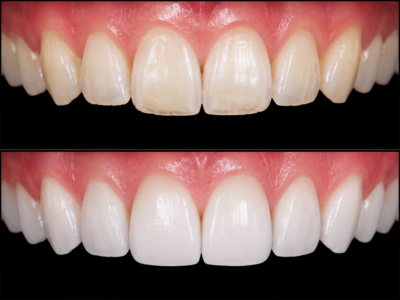 Enamel Microabrasion Treatment in Hesperia, CA