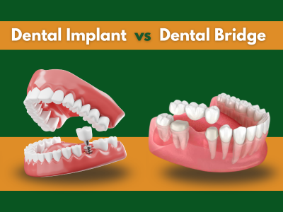 Dental Bridge vs. Dental Implant in Hesperia, California