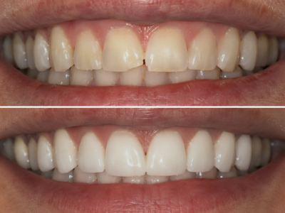 Enamel microabrasion treatment at dentist in Hesperia CA