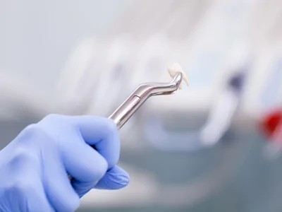 Tooth Extractions - Hesperia dentist