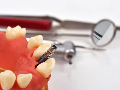 Bone Graft - desert dentist Hesperia ca