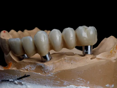 Dental Fixed Bridge
