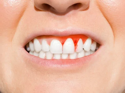 Gum Disease Treatment - Hesperia Dentist