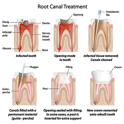 Root Canal Treatment