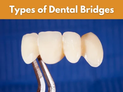 Types of Dental Bridges