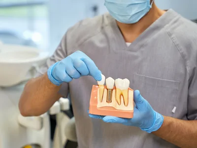 The Benefits of Dental Implants