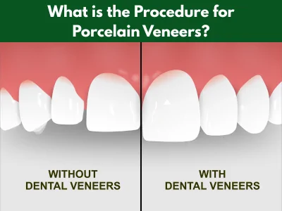Porcelain veneers procedure at Maple Dental Hesperia