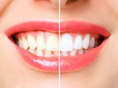 Dental Whitening