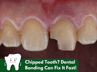 Chipped tooth bonding procedure