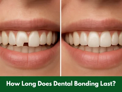 Dental bonding procedure on front tooth
