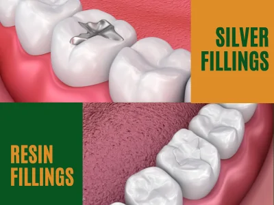 Silver vs Resin Fillings