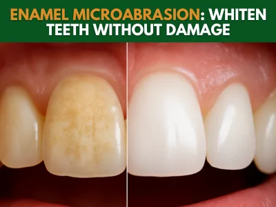 Before and after enamel microabrasion showing a whiter, smoother tooth