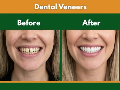 Dental veneers smile transformation before and after smile makeover