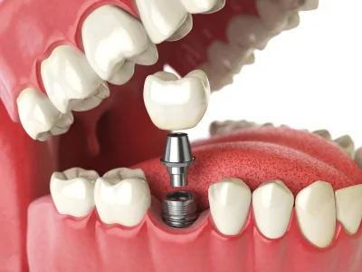Dental implant procedure at Maple Dental in Hesperia CA