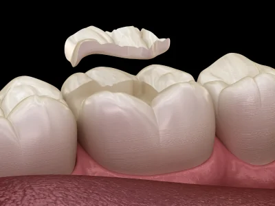 Dental Sealants Hesperia Ca
