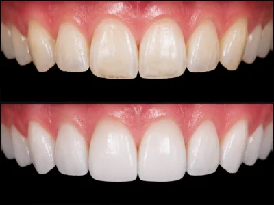 Enamel Microabrasion Treatment in Hesperia, CA